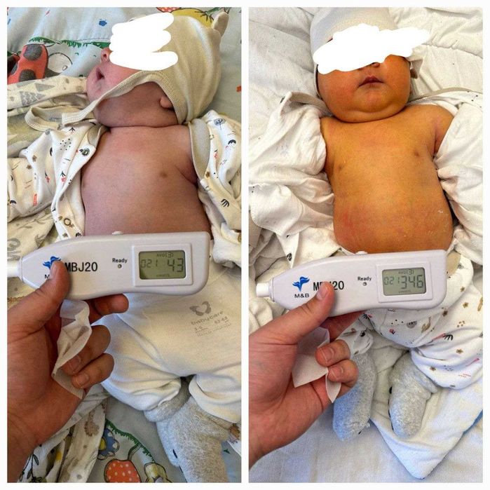 Фотолампа / Фототерапия / Замер билирубина 50,000