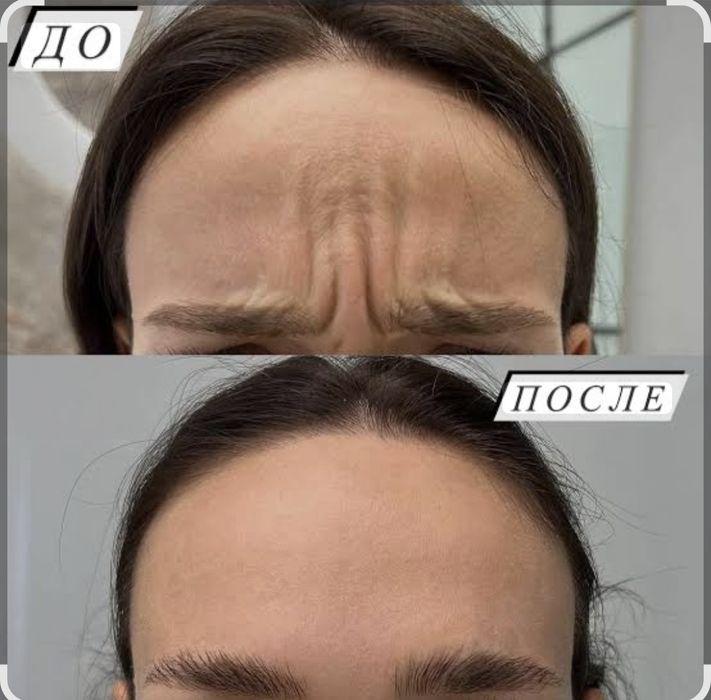 Акция ботокс 55$ Botoks