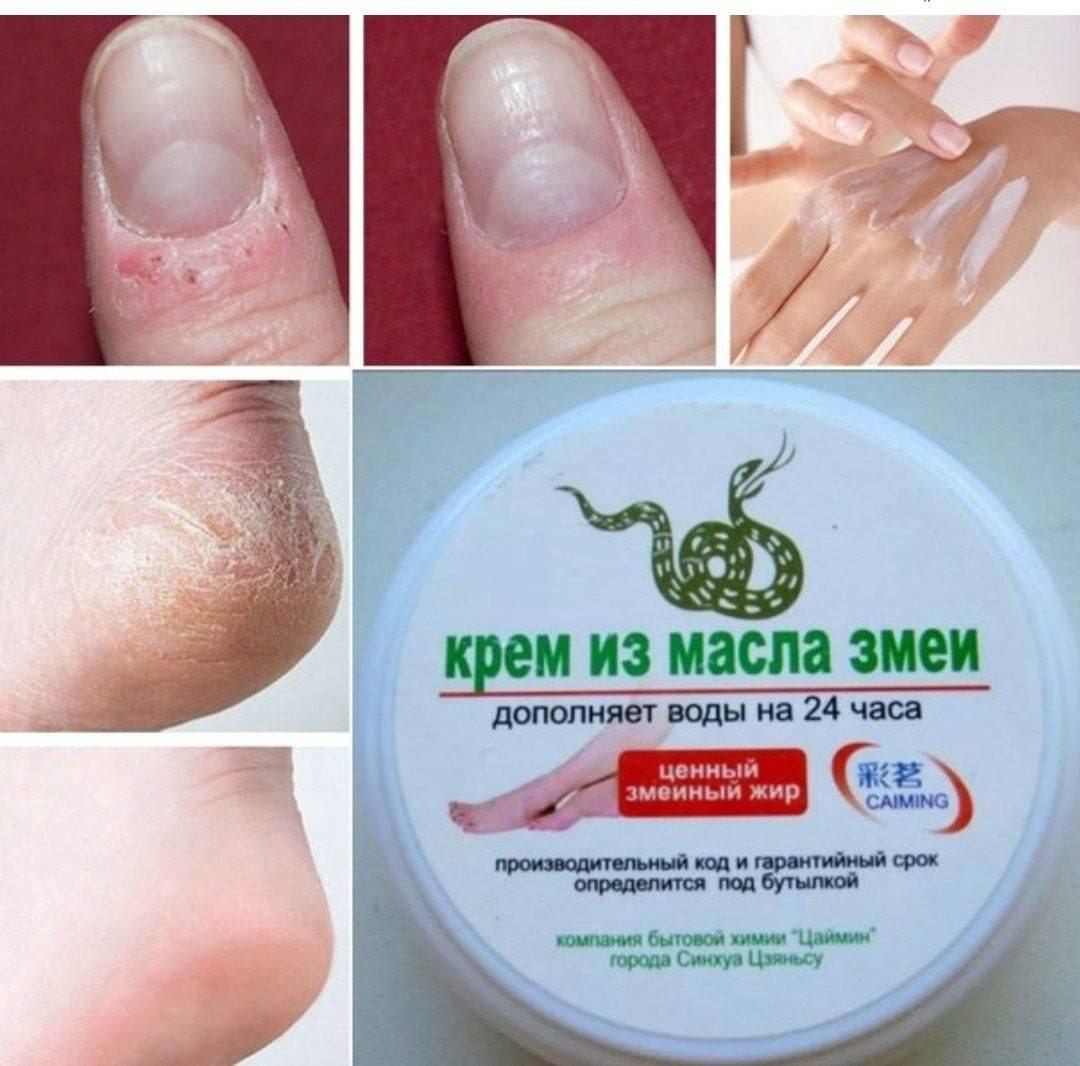 Ilon krem davolovchi oyoqlarga qollar va tana uchun

Yorilgan tovonni