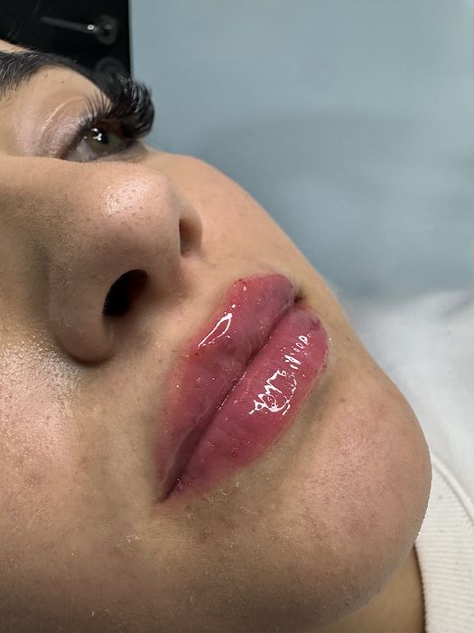 Augmentare buze,menton,riduri