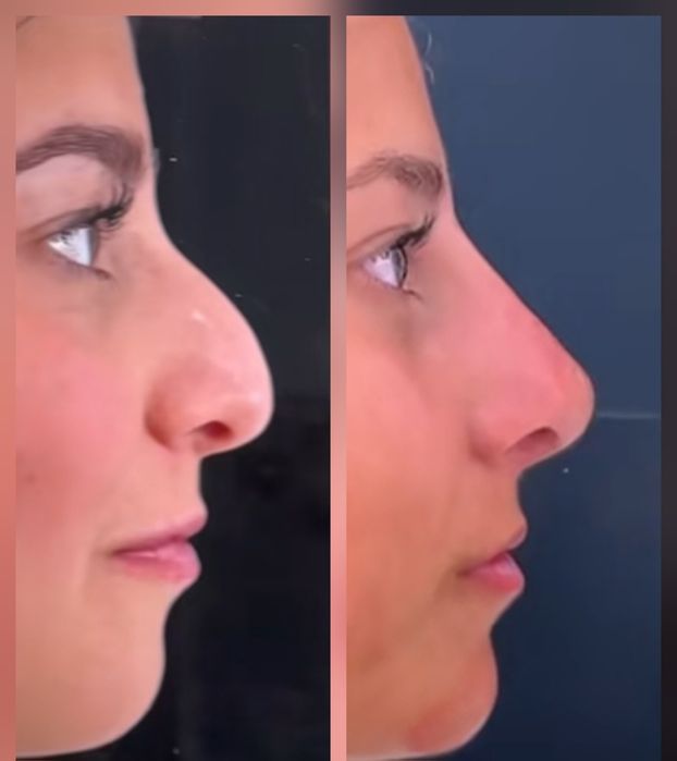 Rinoplastie, mărire buze, micropigmentare