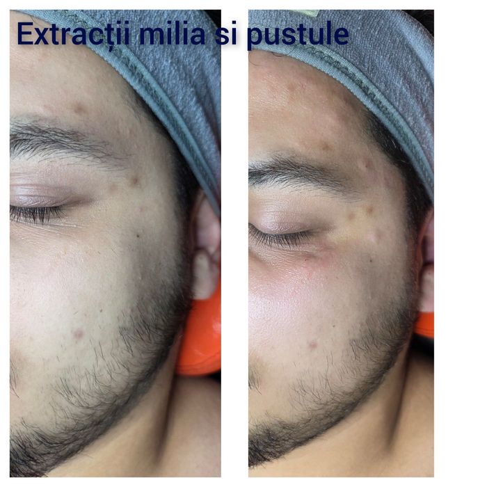 Tratament facial de curățare