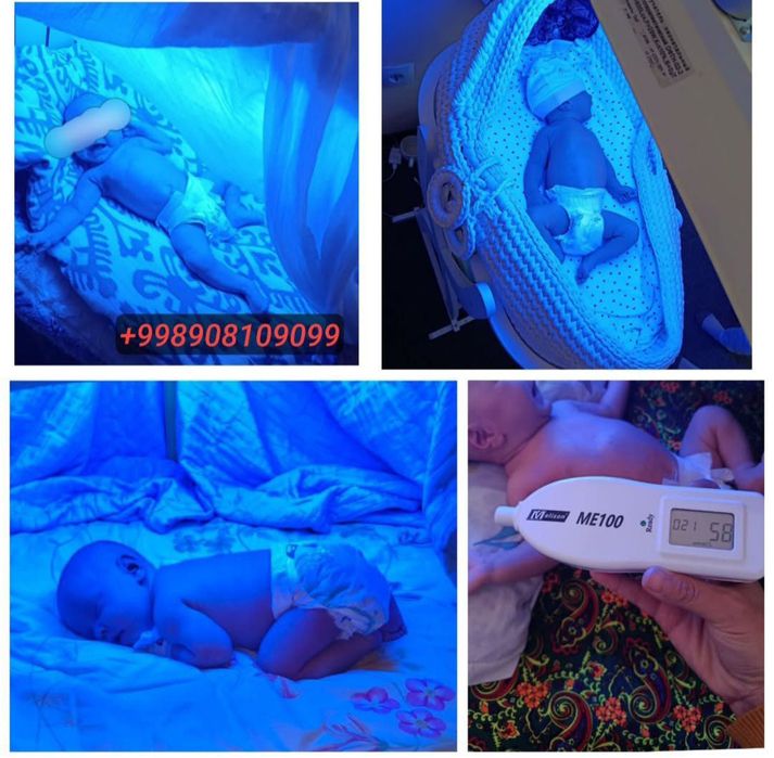 Bolada sariqlikni pasaytirivchi fototerapiya lampasi ijarasi.