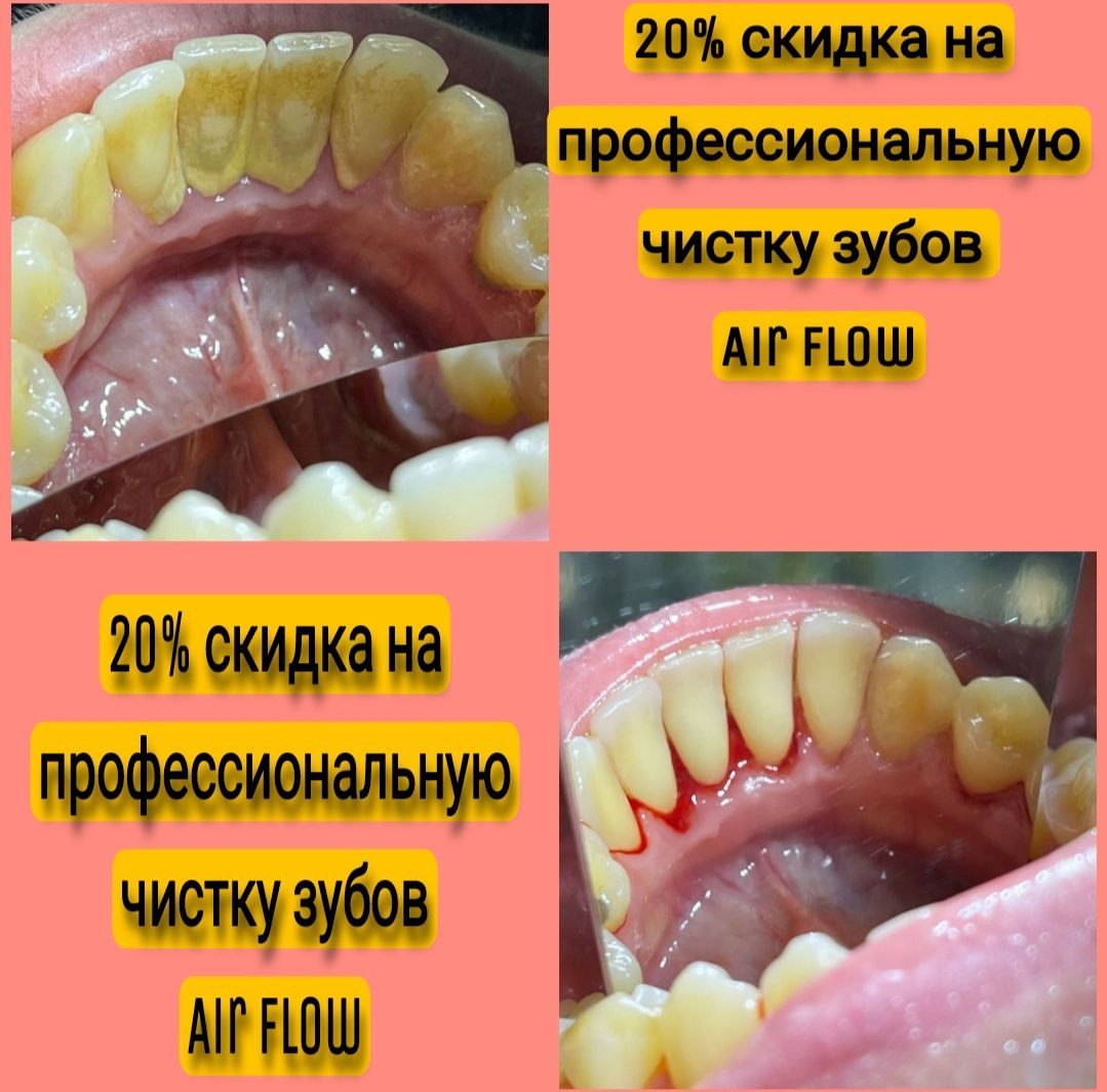 Профессиональная чистка зубов системой Airflow