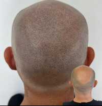 Micropigmentare scalp si barba indesire par tatuaj alopecie chelie