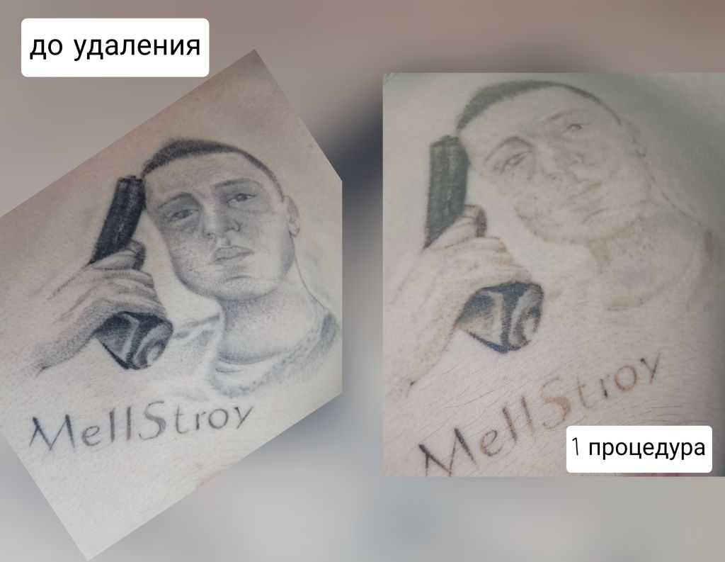 Удаление татуажа и татуировок
