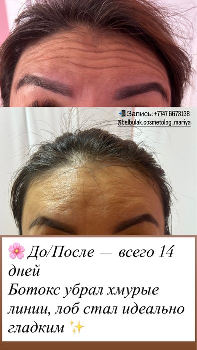 Бельбулак/Косметология / хиджама/ увеличение губ/ботокс