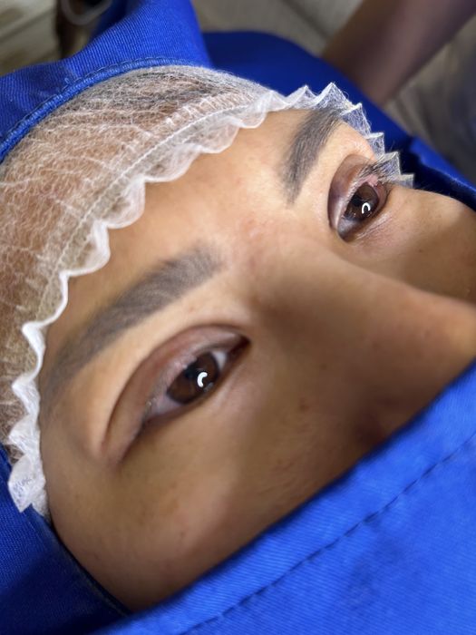 Нитевая блефаропластика 50000