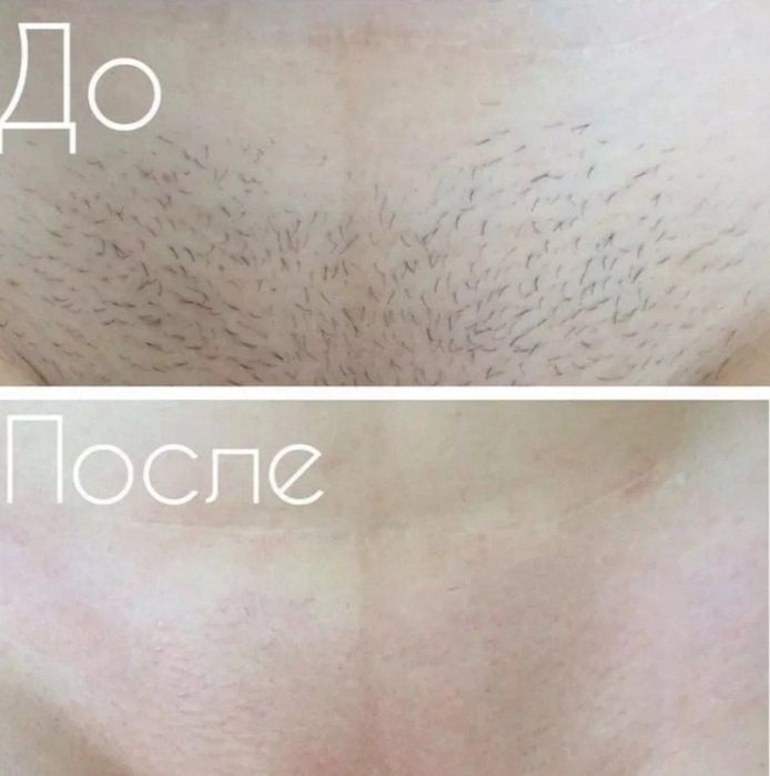 Депиляция мужская и женская
