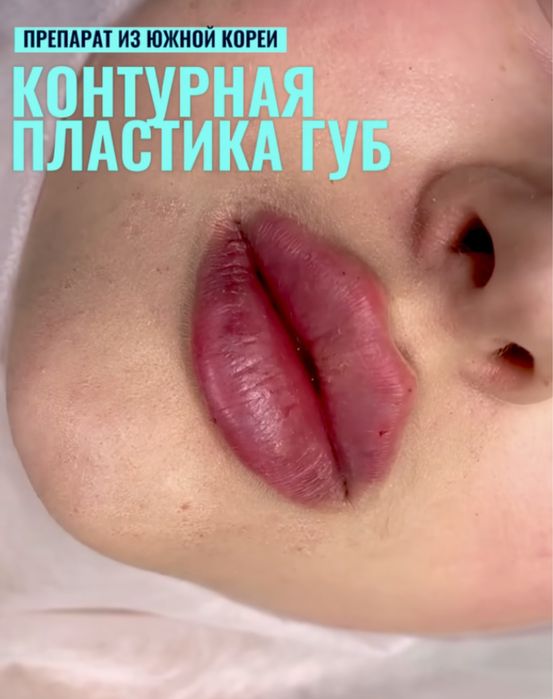 Увеличение губ