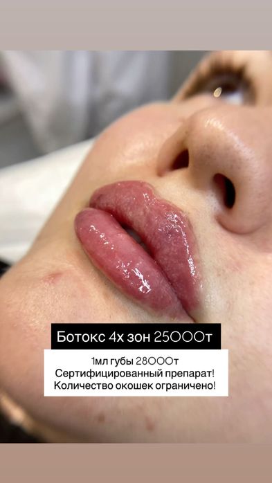 Увеличение губ Алматы! Ботокс алматы! Акция!