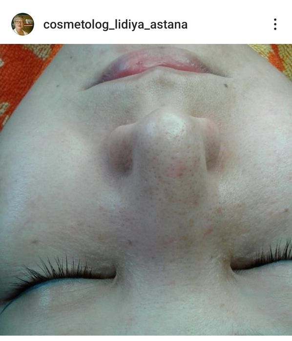 ЧИСТКА ЛИЦА от 5000.