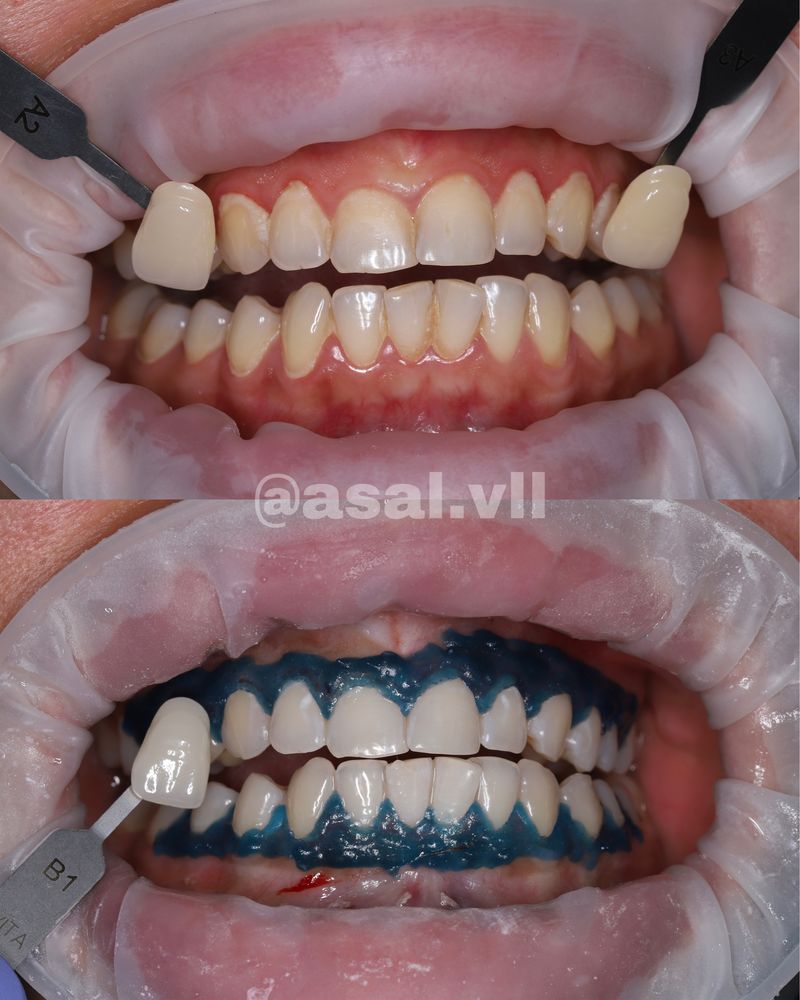 Тиш оркатириш Отбеливание системой Amazing White