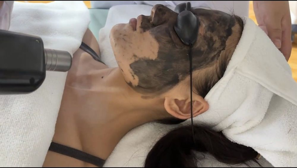 Carbon Peel – ten curat, ferm și luminos