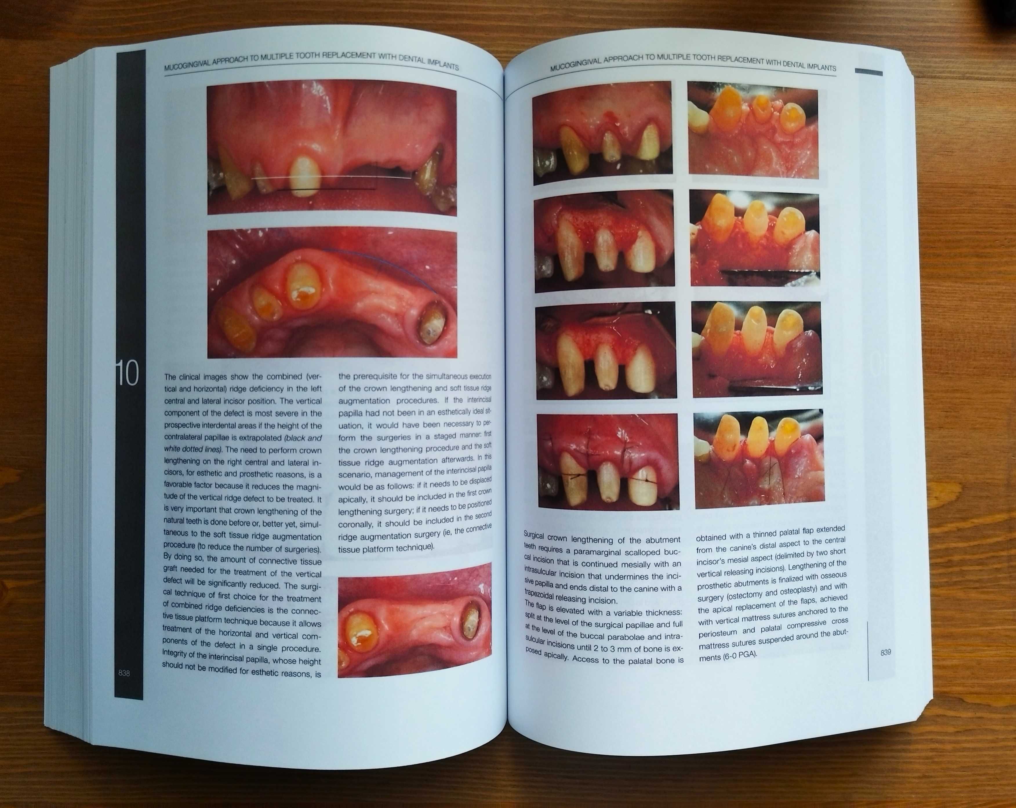 Mucogingival Esthetic Surgery around Implants/ Giovanni Zucchelli 2022