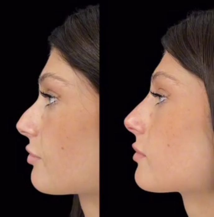 Remodelare nas și buze