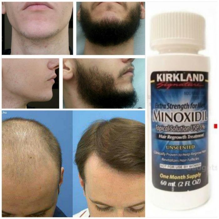 MINOXIDIL Для роста волос и бороды