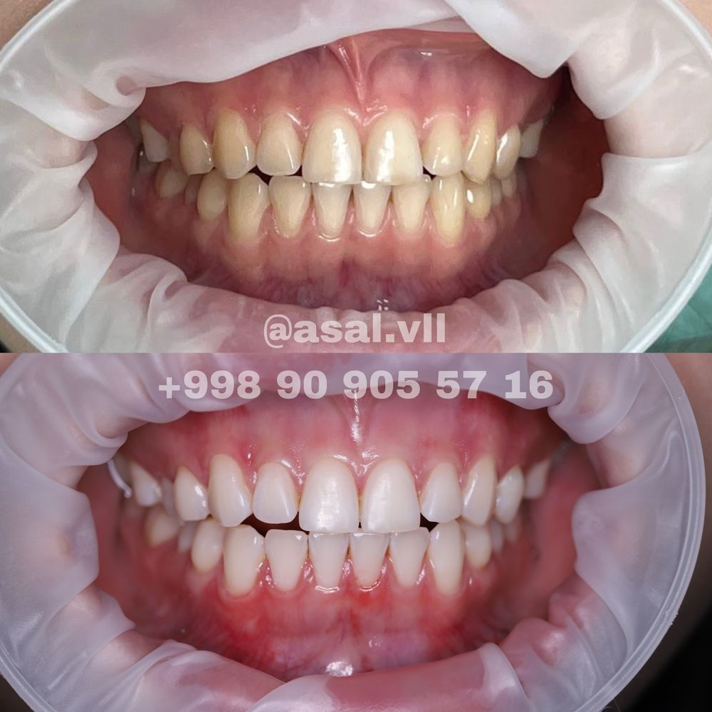 Отбеливание зубов системой Amazing White Premium