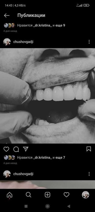 зубные протезы с гарантией