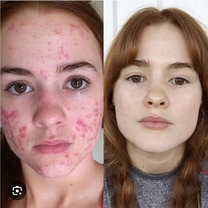 Угри,акне.прыши личение.