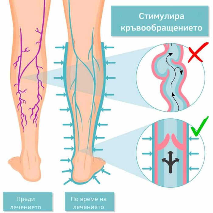 Апарат за венозна тренировка и облекчение на тежестта в краката