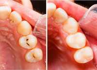 Зъбобол? Предлагайте безплатно лечение на коренови канали.