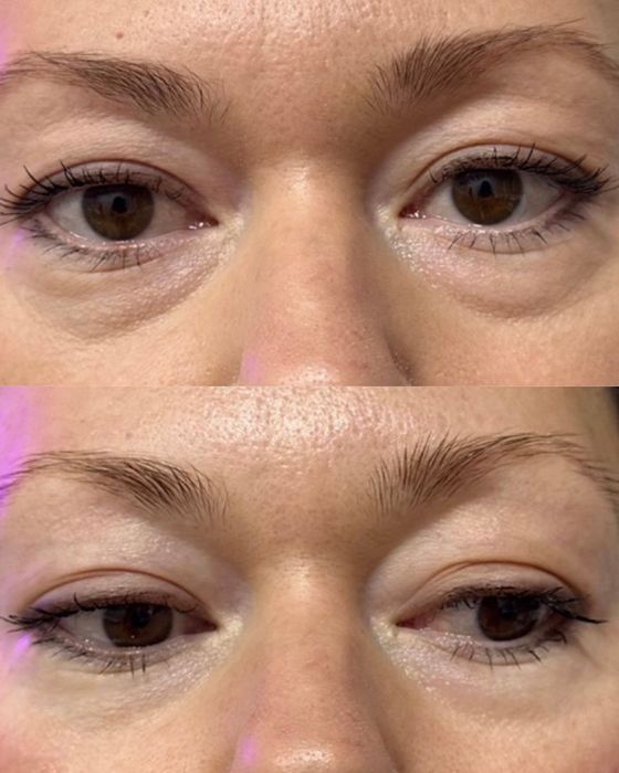 Микроигольчатый RF-лифтинг