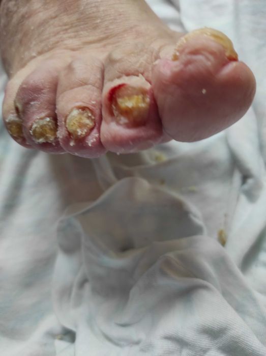 Медицински педикюр по домовете