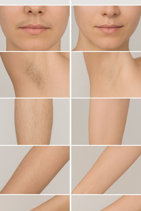 Epilare definitivă cu laser profesional: Alexandrite + Diode + ND:YAG