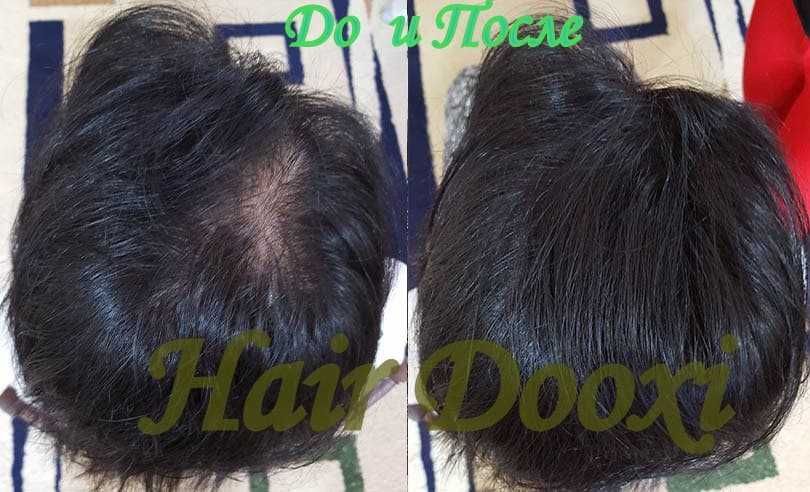 Hair Dooxi-От выпадения и для роста волос!
