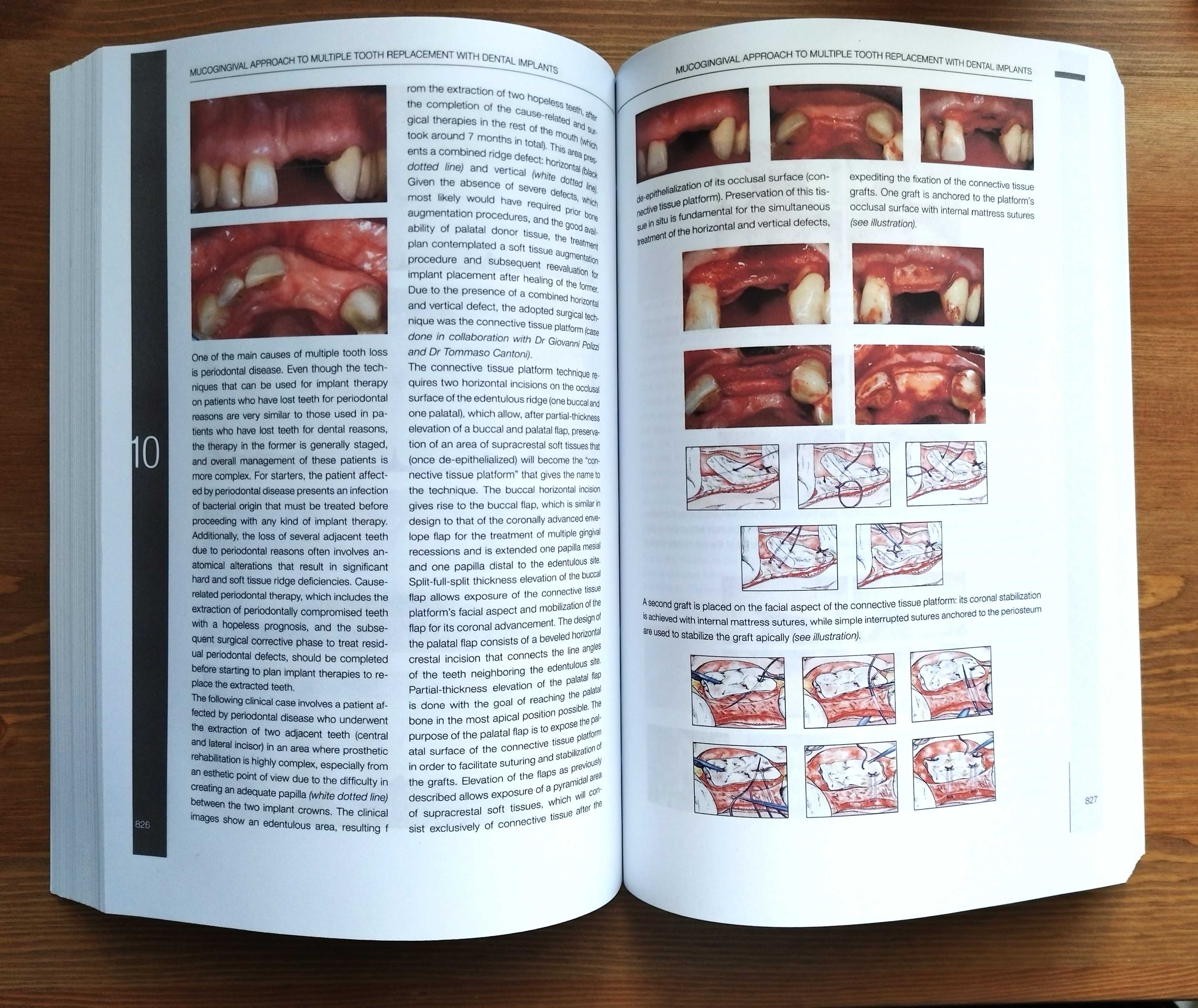 Mucogingival Esthetic Surgery around Implants/ Giovanni Zucchelli 2022