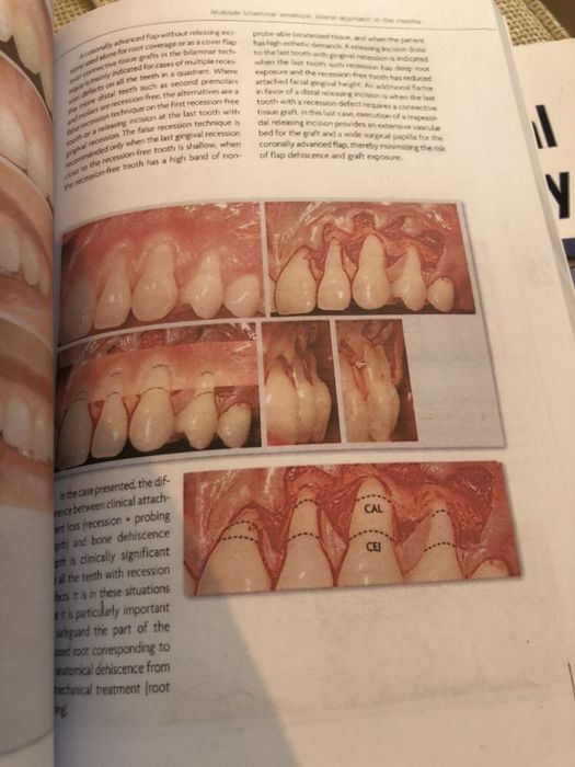 Mucogingival Esthetic Surgery - Giovanni Zucchelli