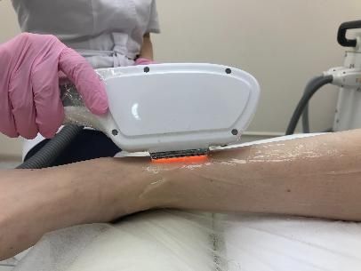Лазерная эпиляция Фото эпиляция