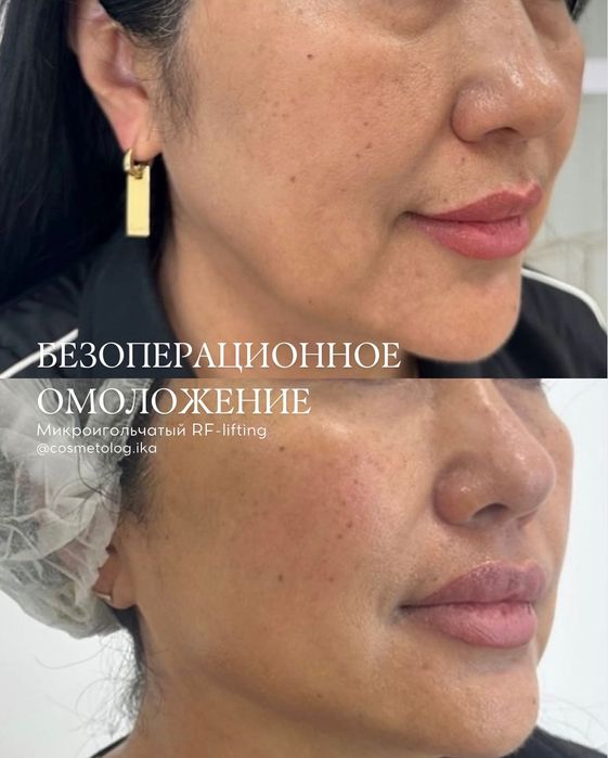 Безоперационное омоложение лица