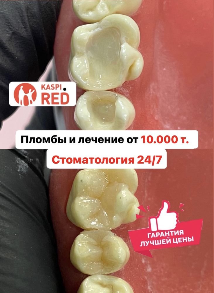 Лечение зубов/Пломба от 9.990.  Астана Нурсултан