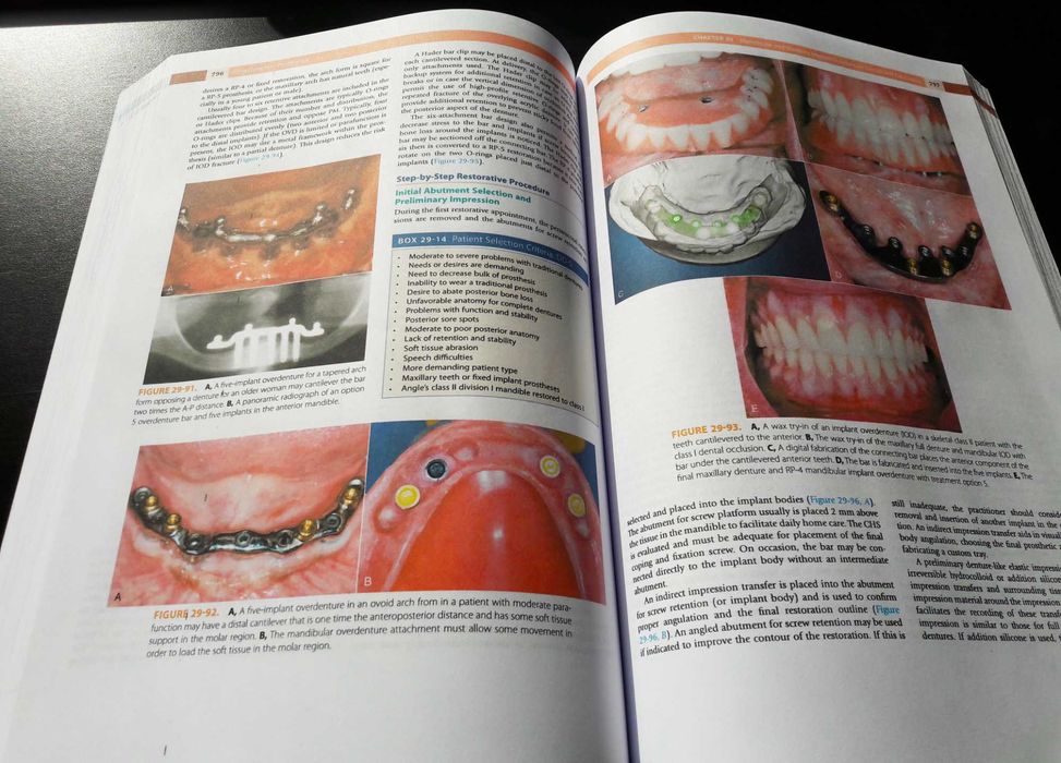 Dental Implant Prosthetics: Carl Misch - (Implantologie protetică)