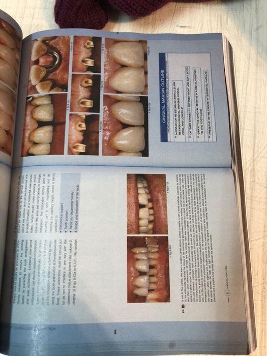 Esthetic Rehabilitation in Fixed Prosthodontics, Volume 1 & 2 FRADEANI