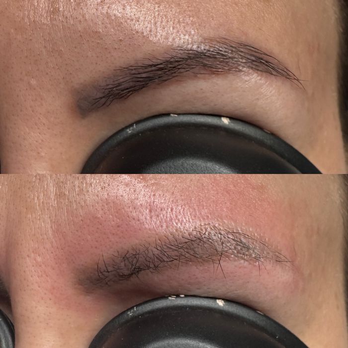 Stergere tatuaje cu laser nd:Yag