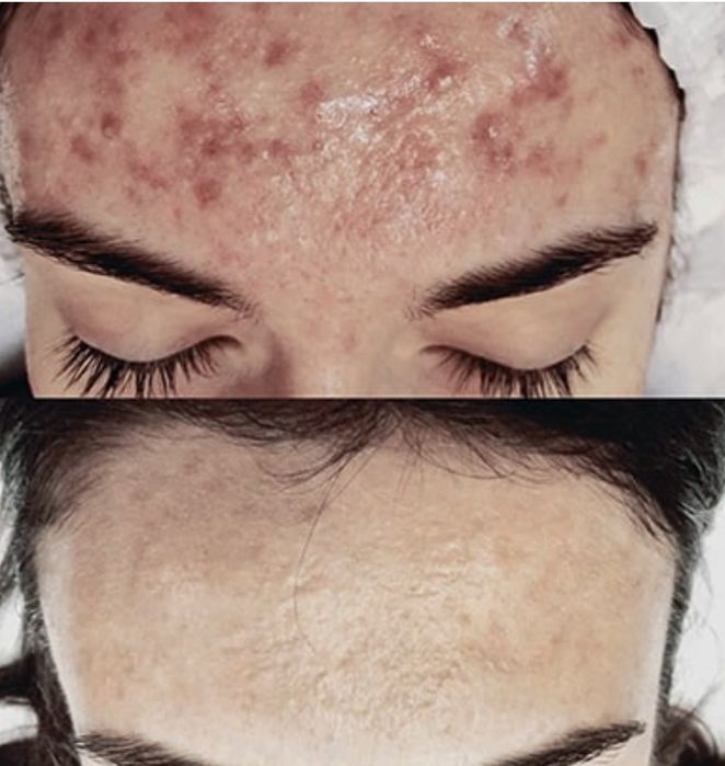 Угри,акне.прыши личение.