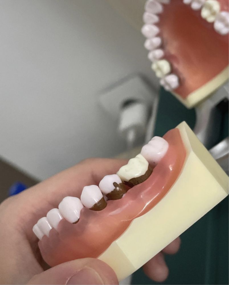 Model boală parodontală cu dinţi detaşabili cu şurub - 4023
