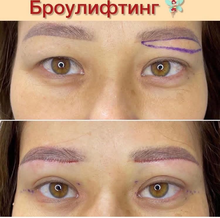 Броулифтинг по акции 80.000
