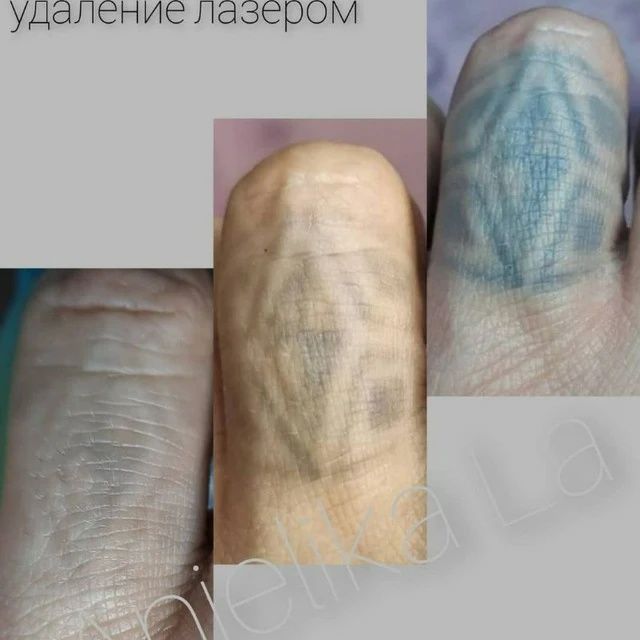 Предлагаю процедуру удаления тату лазером