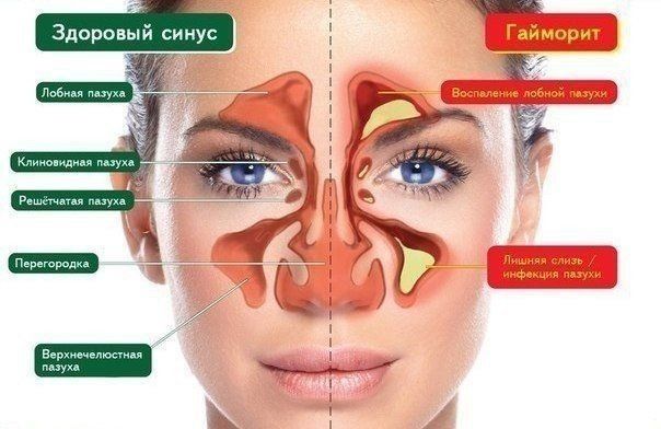 Гайморит / синусит / фронтит емдейміз