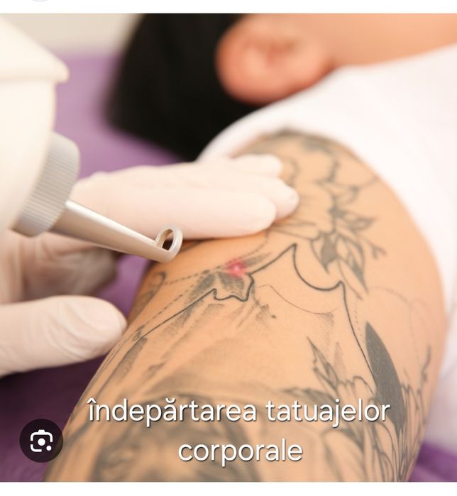 Îndepărtare tatuaj cu laser