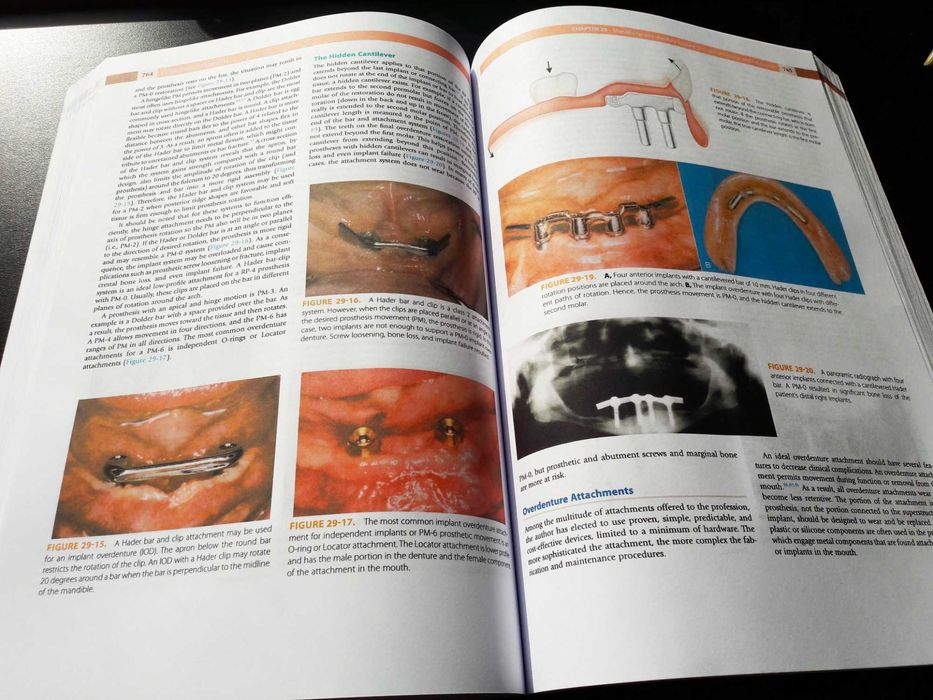 Dental Implant Prosthetics: Carl Misch - (Implantologie protetică)