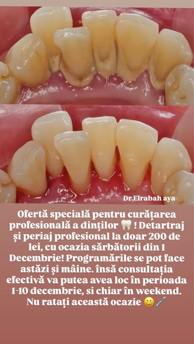 Detartraj profesional