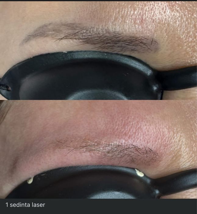 Stergere tatuaje cu laser nd:Yag