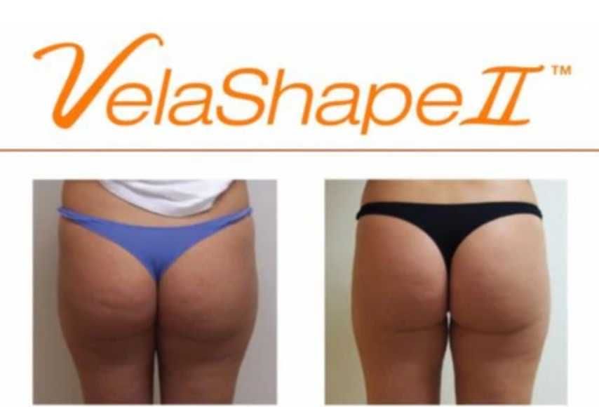 De vanzare aparat remodelare corporala Velashape II