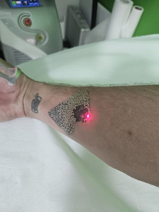 Îndepărtare tatuaje