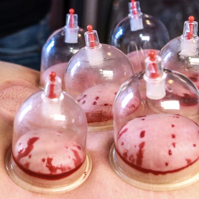 Hijama qilamiz (uyga borib)